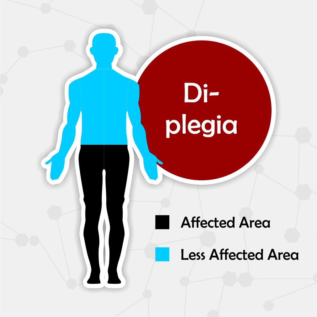 Diplegia - Paralysis Recovery Time Paralysis Recovery Time