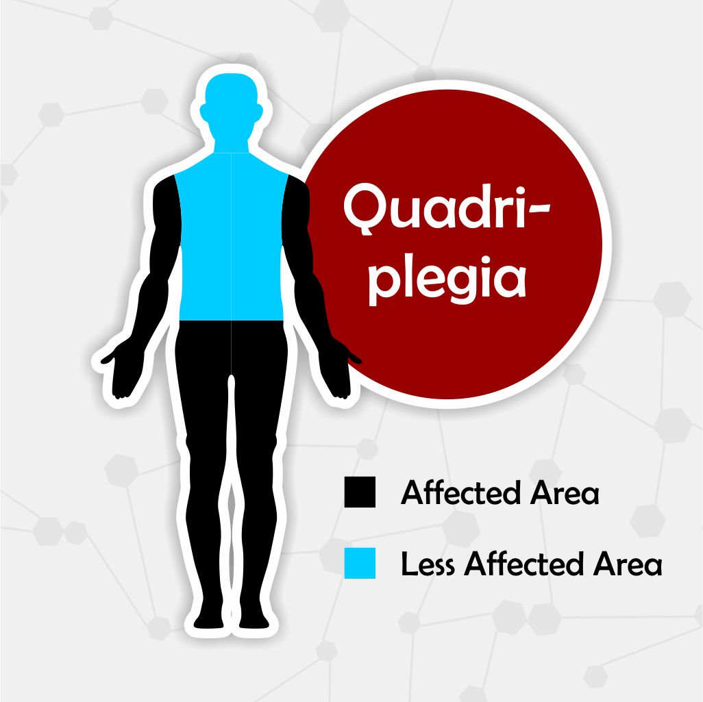 Quadriplegia - Paralysis Recovery Time Paralysis Recovery Time