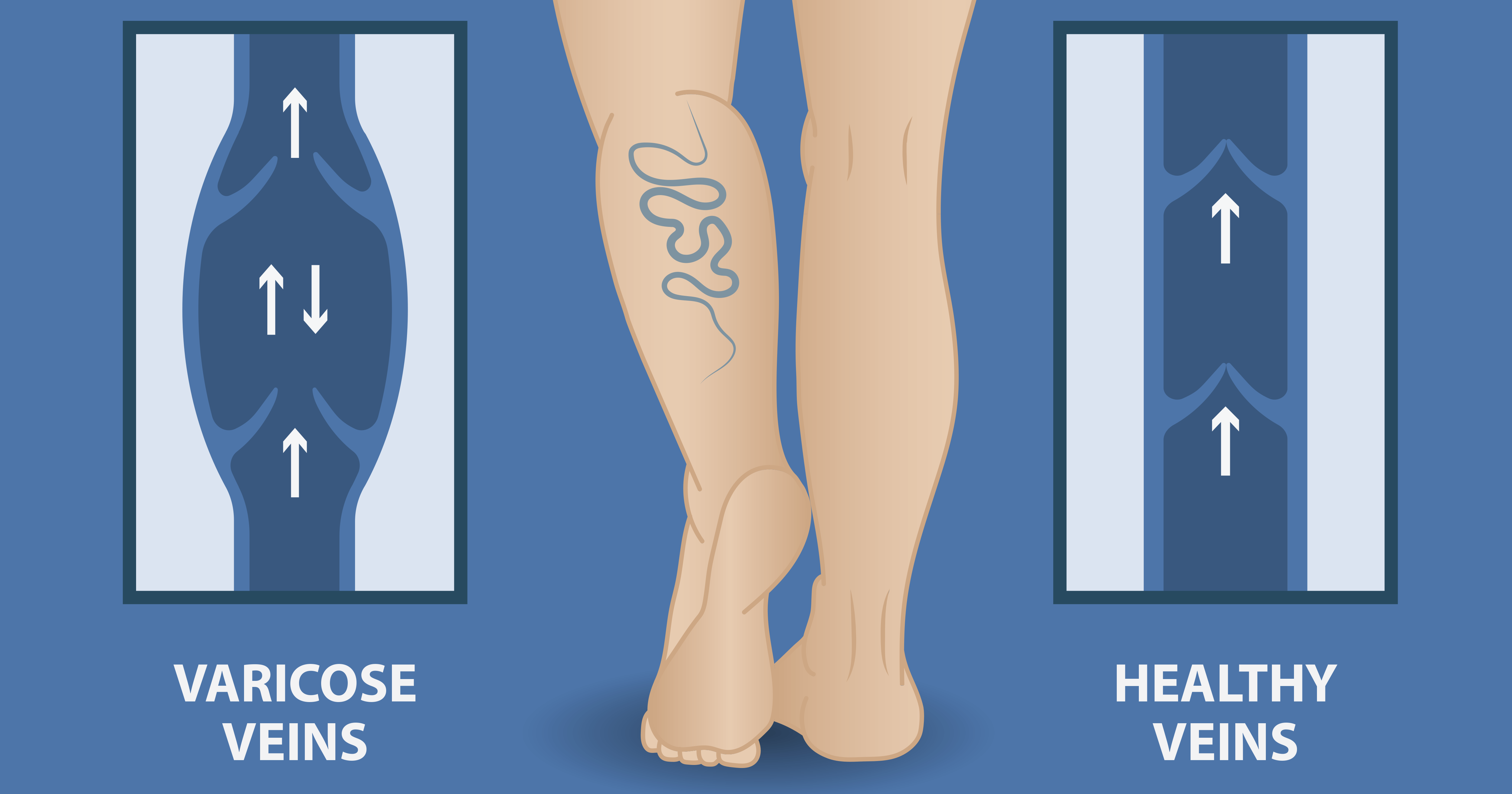 , Varicose Veins: All You Need To Know, Care24